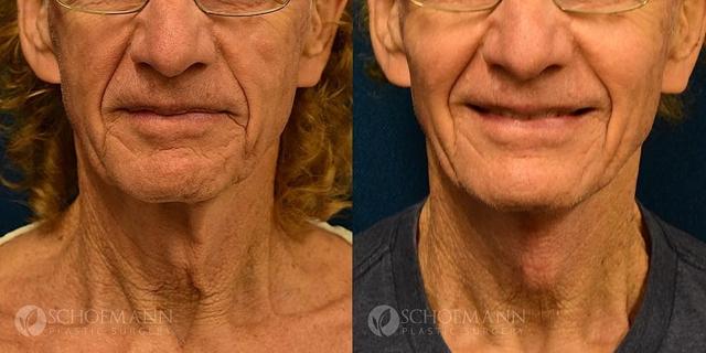Neck Lift result at Dermacare Encinitas at Schoemann Plastic Surgery in Encinitas, CA