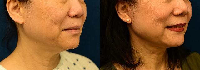 Deep Plane Facelift result at Dermacare Encinitas at Schoemann Plastic Surgery in Encinitas, CA