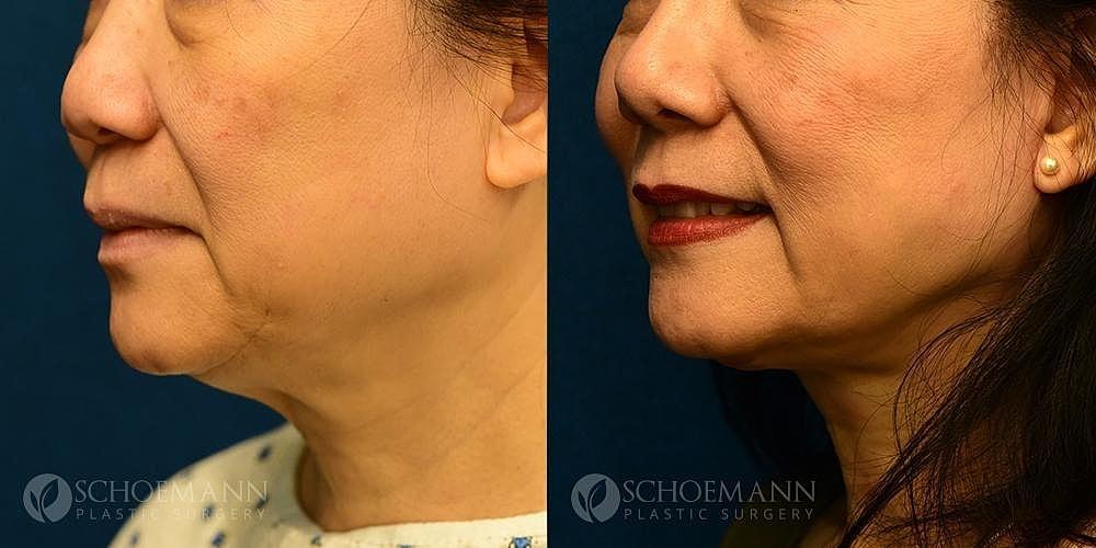 Dermacare Encinitas at Schoemann Plastic Surgery neck lift result — Encinitas, CA