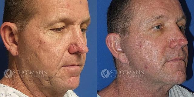 Deep Plane Facelift result at Dermacare Encinitas at Schoemann Plastic Surgery in Encinitas, CA