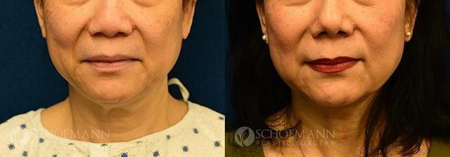 Deep Plane Facelift result at Dermacare Encinitas at Schoemann Plastic Surgery in Encinitas, CA