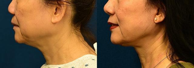 Deep Plane Facelift result at Dermacare Encinitas at Schoemann Plastic Surgery in Encinitas, CA
