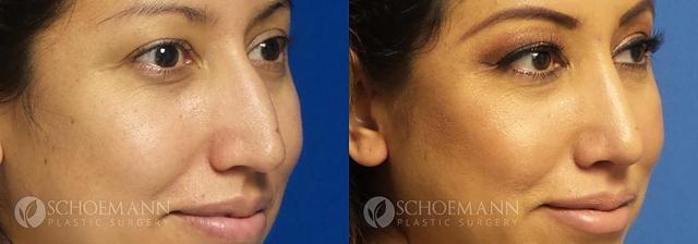 Rhinoplasty result at Dermacare Encinitas at Schoemann Plastic Surgery in Encinitas, CA