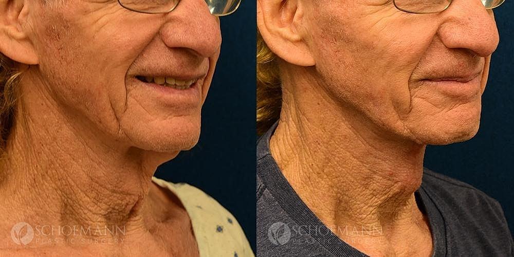 Dermacare Encinitas at Schoemann Plastic Surgery neck lift result — Encinitas, CA