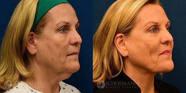 Neck Lift result at Dermacare Encinitas at Schoemann Plastic Surgery in Encinitas, CA