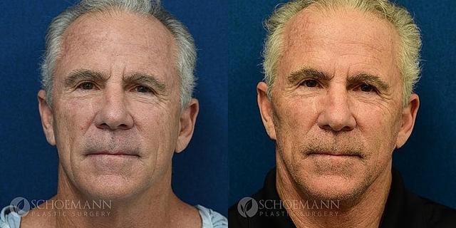 Deep Plane Facelift result at Dermacare Encinitas at Schoemann Plastic Surgery in Encinitas, CA
