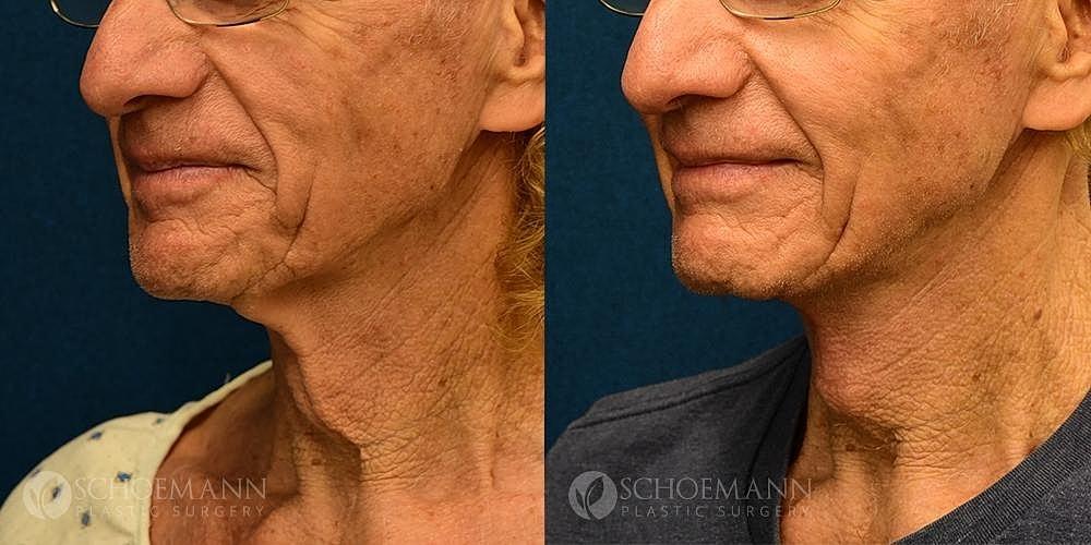 Dermacare Encinitas at Schoemann Plastic Surgery neck lift result — Encinitas, CA