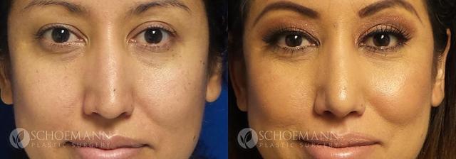 Rhinoplasty result at Dermacare Encinitas at Schoemann Plastic Surgery in Encinitas, CA
