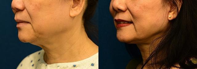 Deep Plane Facelift result at Dermacare Encinitas at Schoemann Plastic Surgery in Encinitas, CA