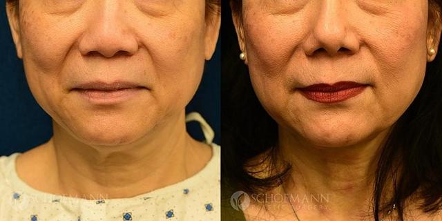 Neck Lift result at Dermacare Encinitas at Schoemann Plastic Surgery in Encinitas, CA