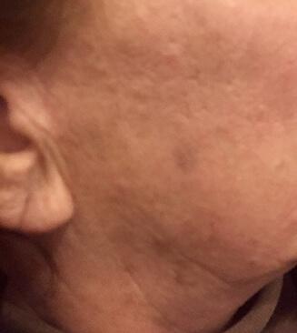 SkinTight MedSpa skin tightening after — New York, NY