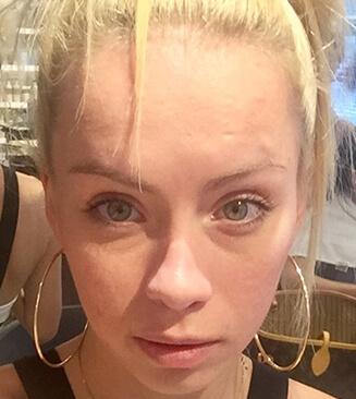 SkinTight MedSpa skin tightening after — New York, NY