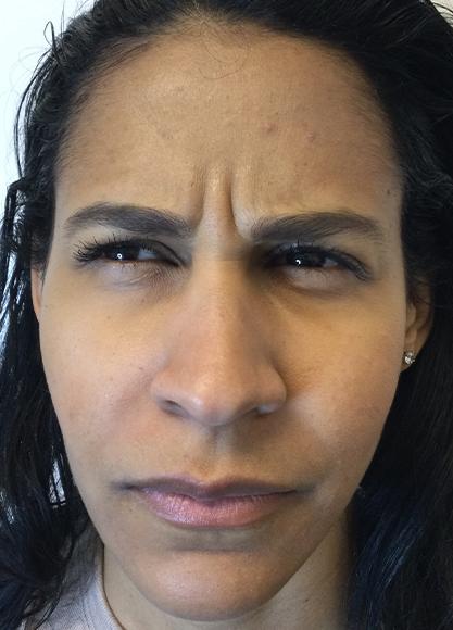 Botox result at SkinTight MedSpa in New York, NY