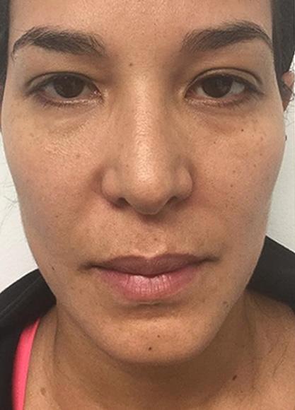 SkinTight MedSpa skin tightening result — New York, NY