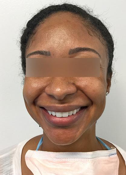SkinTight MedSpa skin tightening result — New York, NY