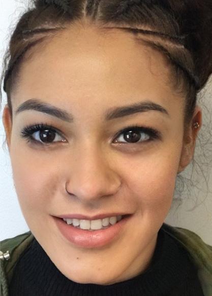 SkinTight MedSpa botox after — New York, NY