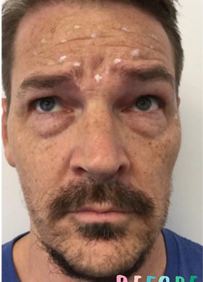 SkinTight MedSpa skin tightening result — New York, NY