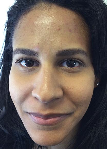 SkinTight MedSpa botox result — New York, NY