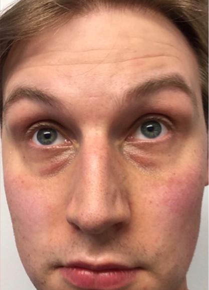 SkinTight MedSpa skin tightening result — New York, NY