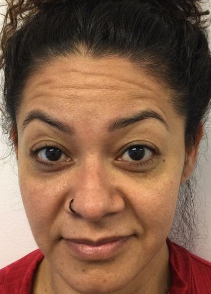 SkinTight MedSpa botox result — New York, NY