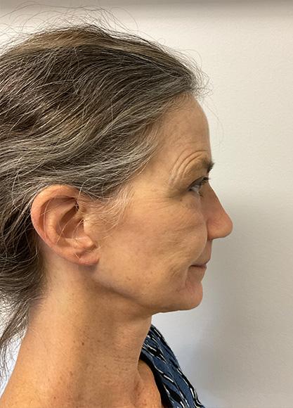 SkinTight MedSpa botox result — New York, NY