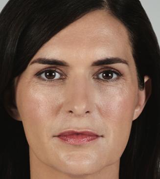 SkinTight MedSpa skin tightening result — New York, NY