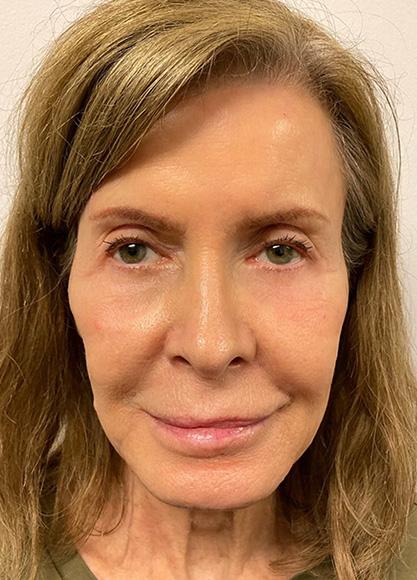 SkinTight MedSpa botox result — New York, NY