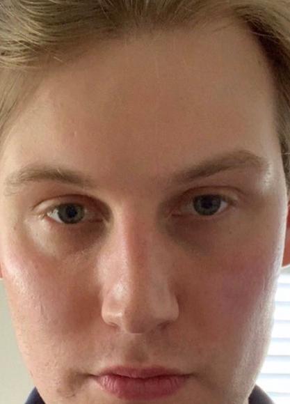 SkinTight MedSpa skin tightening result — New York, NY