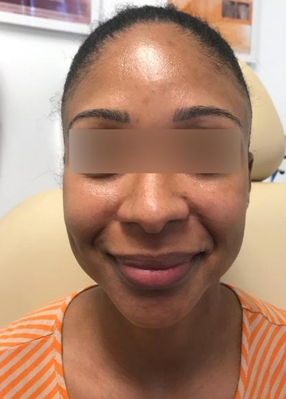 SkinTight MedSpa skin tightening result — New York, NY
