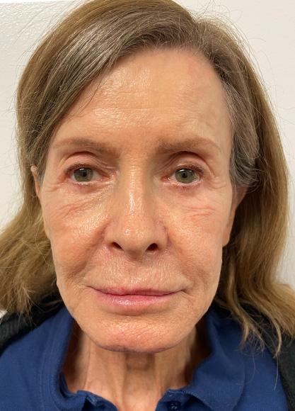 SkinTight MedSpa botox result — New York, NY