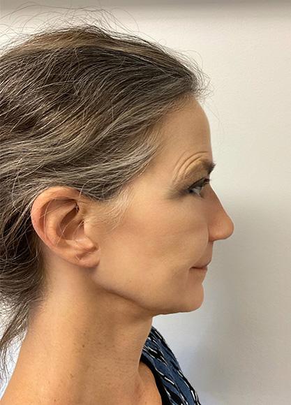 SkinTight MedSpa botox result — New York, NY