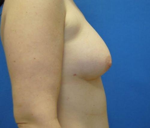 Bruno Brown Plastic Surgery breast fat transfer after — Chevy Chase, MD