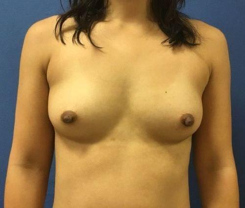 Bruno Brown Plastic Surgery breast fat transfer after — Chevy Chase, MD