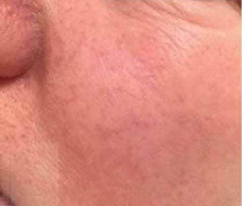 Bruno Brown Plastic Surgery photofacial after — Chevy Chase, MD