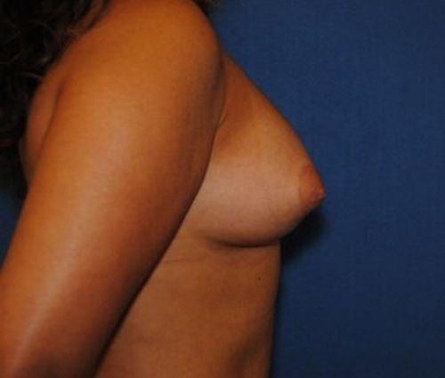 Bruno Brown Plastic Surgery breast fat transfer after — Chevy Chase, MD