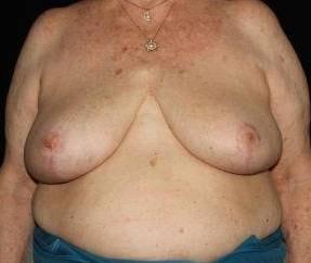 Cirillo Center for Plastic Surgery breast reduction after โ Bryn Mawr, PA