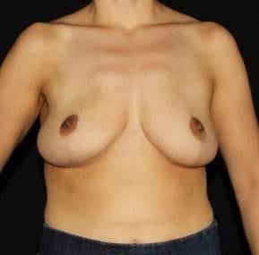 Cirillo Center for Plastic Surgery breast reduction after โ Bryn Mawr, PA