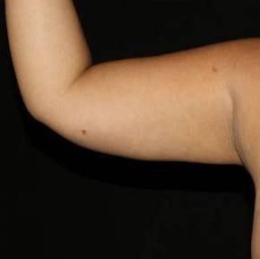 Cirillo Center for Plastic Surgery liposuction after โ Bryn Mawr, PA