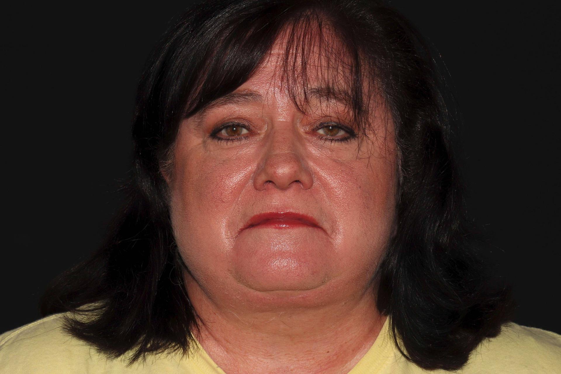 Cirillo Center for Plastic Surgery facelift after โ Bryn Mawr, PA