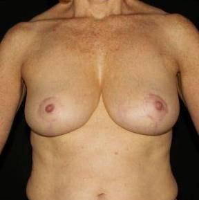 Cirillo Center for Plastic Surgery breast reduction after — Bryn Mawr, PA