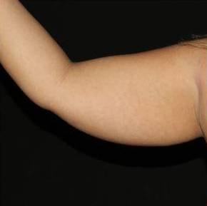 Brazilian Butt Lift before at Cirillo Center for Plastic Surgery in Bryn Mawr, PA