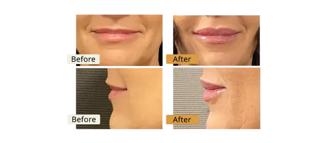 Lip Filler result at ELE'VI Skin & Medical Aesthetics in Omaha, NE