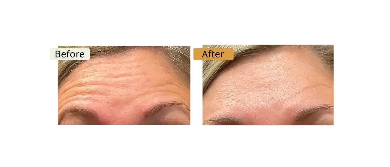 ELE'VI Skin & Medical Aesthetics botox result — Omaha, NE