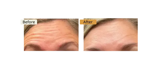 Botox result at ELE'VI Skin & Medical Aesthetics in Omaha, NE