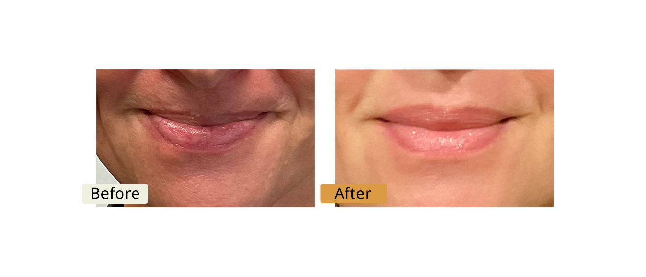 ELE'VI Skin & Medical Aesthetics lip filler result — Omaha, NE