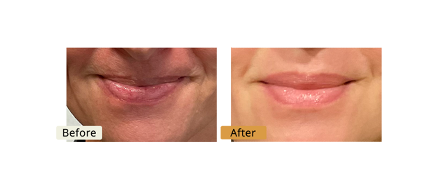 Lip Filler result at ELE'VI Skin & Medical Aesthetics in Omaha, NE