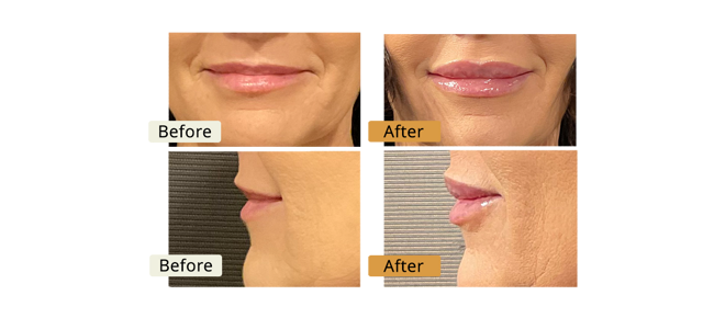 Lip Filler result at ELE'VI Skin & Medical Aesthetics in Omaha, NE