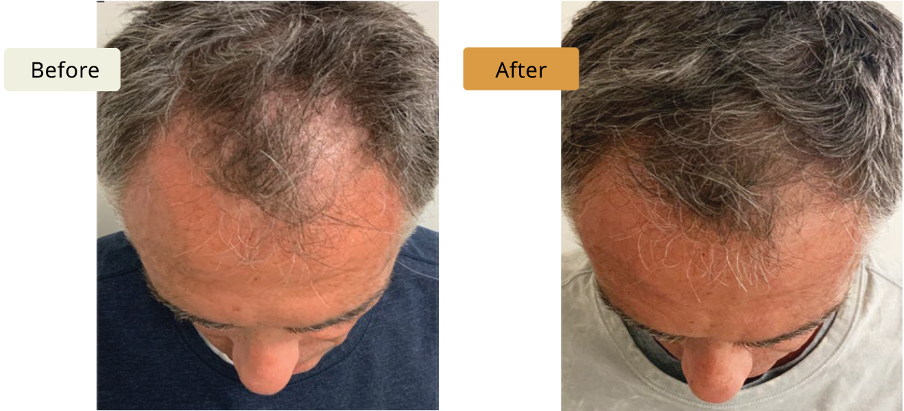 ELE'VI Skin & Medical Aesthetics hair restoration result — Omaha, NE