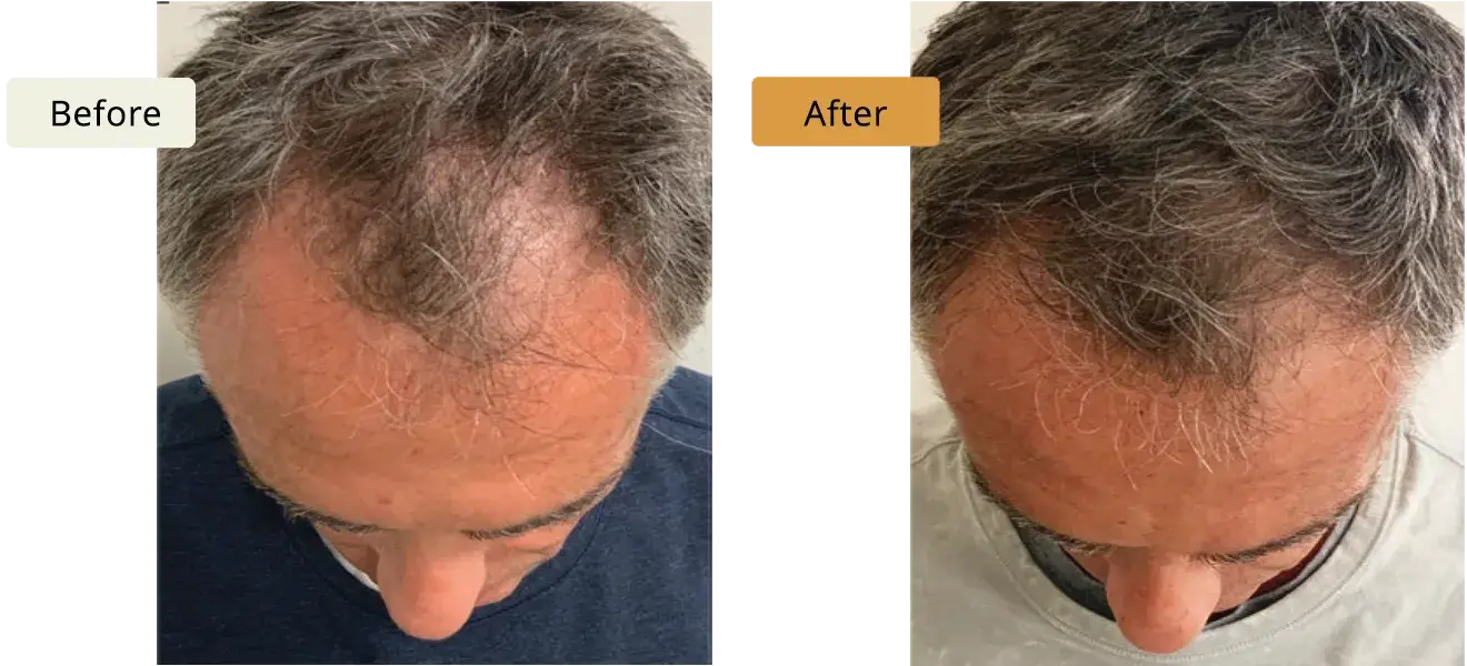 ELE'VI Skin & Medical Aesthetics hair restoration result — Omaha, NE