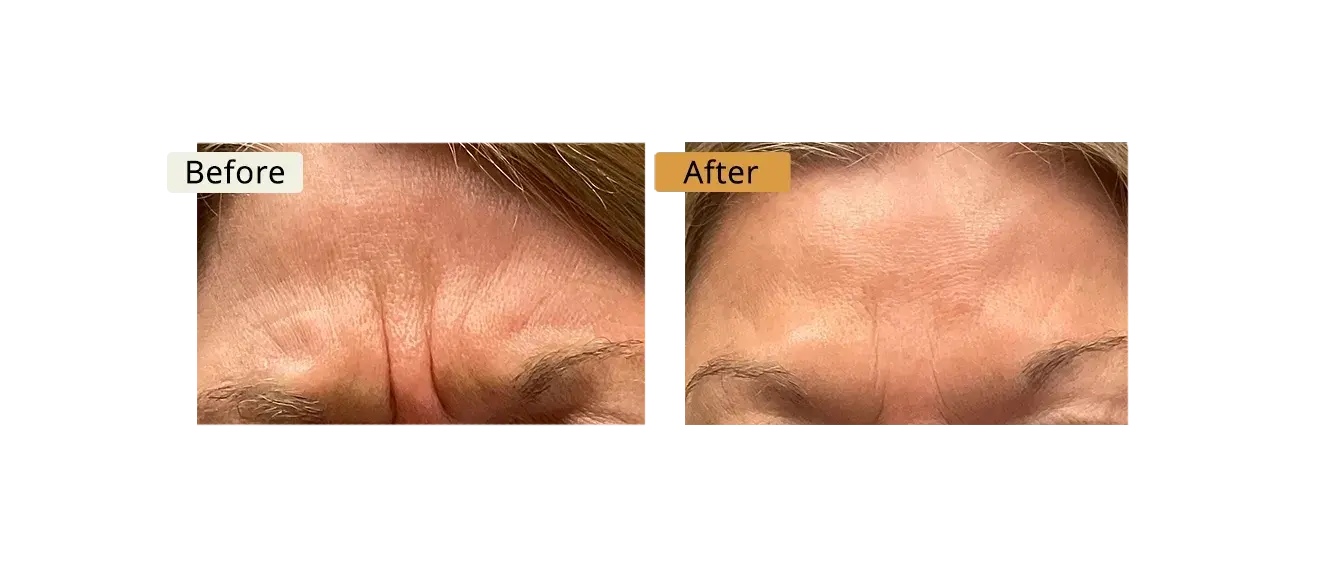 ELE'VI Skin & Medical Aesthetics botox result — Omaha, NE